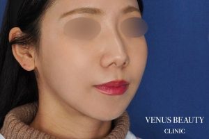 糸リフト＋脂肪吸引 施術後