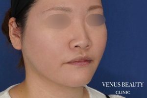 糸リフト＋脂肪吸引 施術後