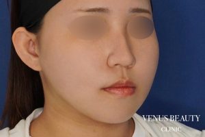 糸リフト＋脂肪吸引 施術後