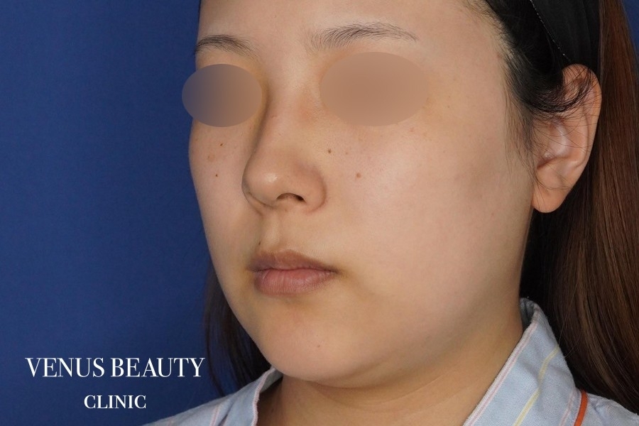 糸リフト＋脂肪吸引 施術前