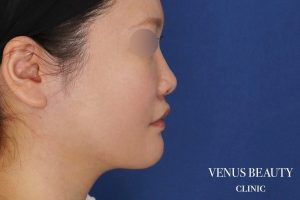 糸リフト＋脂肪吸引 施術後