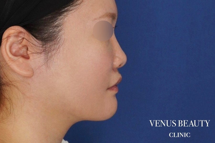 糸リフト＋脂肪吸引 施術後