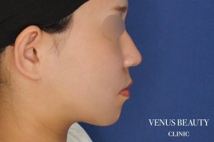 糸リフト＋脂肪吸引 施術後