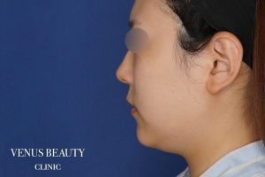 糸リフト＋脂肪吸引 施術前