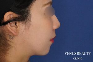 糸リフト＋脂肪吸引 施術後