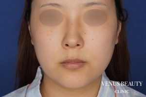 糸リフト＋脂肪吸引 施術前