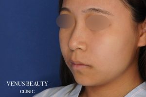 糸リフト＋脂肪吸引 施術前