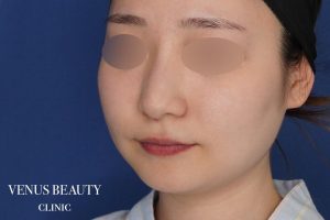 糸リフト＋脂肪吸引 施術前