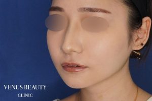 糸リフト＋脂肪吸引 施術後