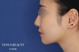 糸リフト＋脂肪吸引 施術後