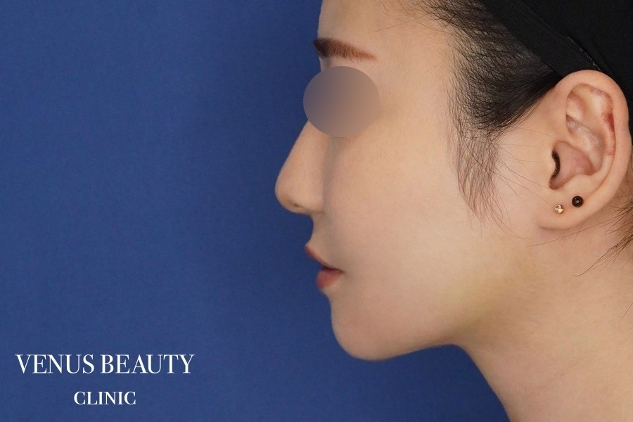 糸リフト＋脂肪吸引 施術後