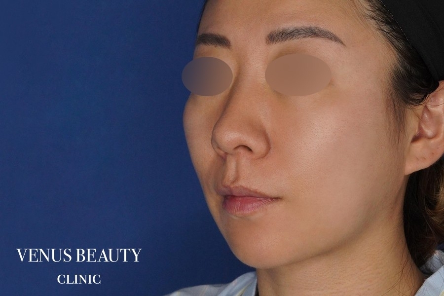 糸リフト＋脂肪吸引 施術前