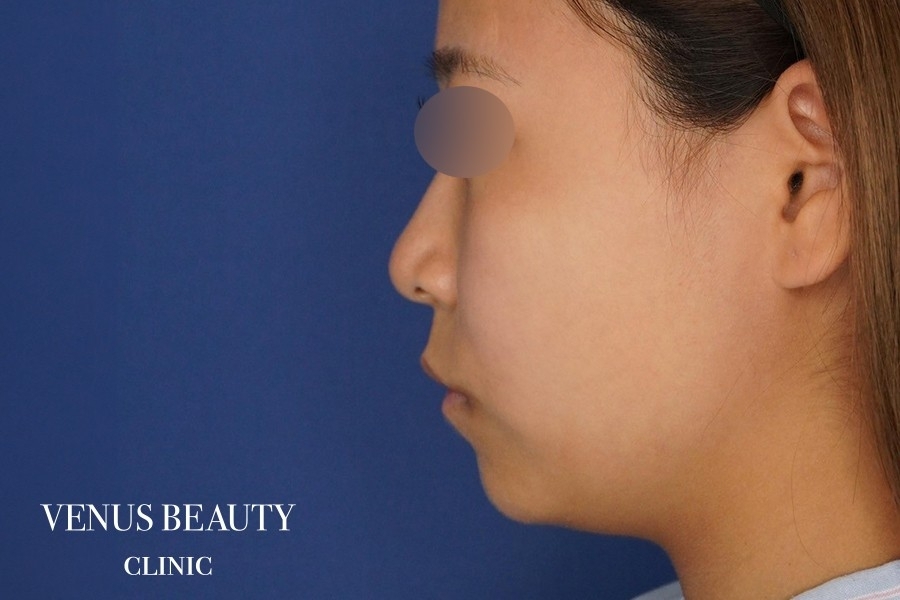 糸リフト＋脂肪吸引 施術前