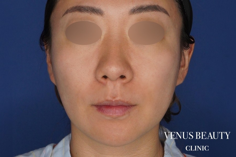 糸リフト＋脂肪吸引 施術前