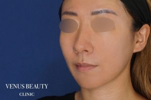 糸リフト＋脂肪吸引 施術後