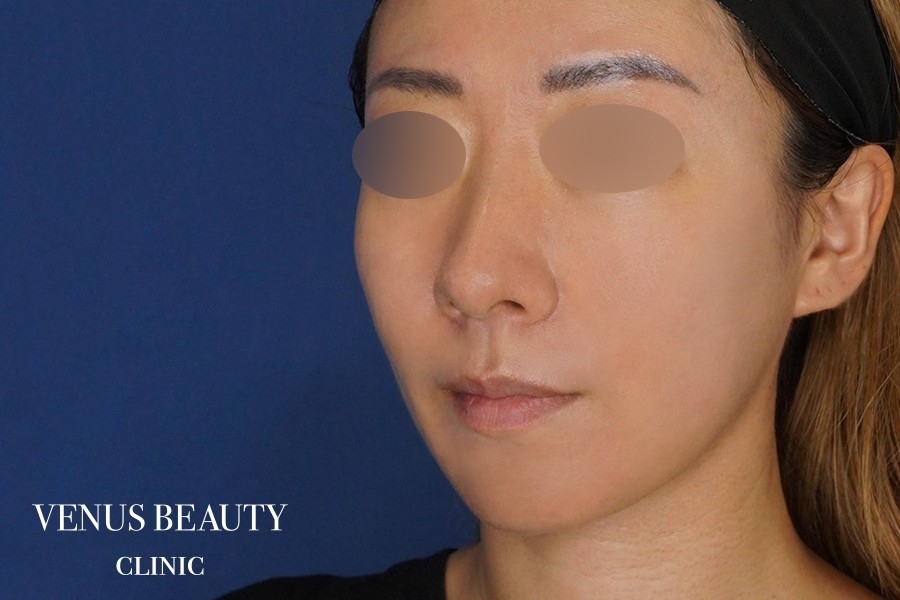 糸リフト＋脂肪吸引 施術後