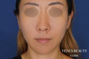 糸リフト＋脂肪吸引 施術後