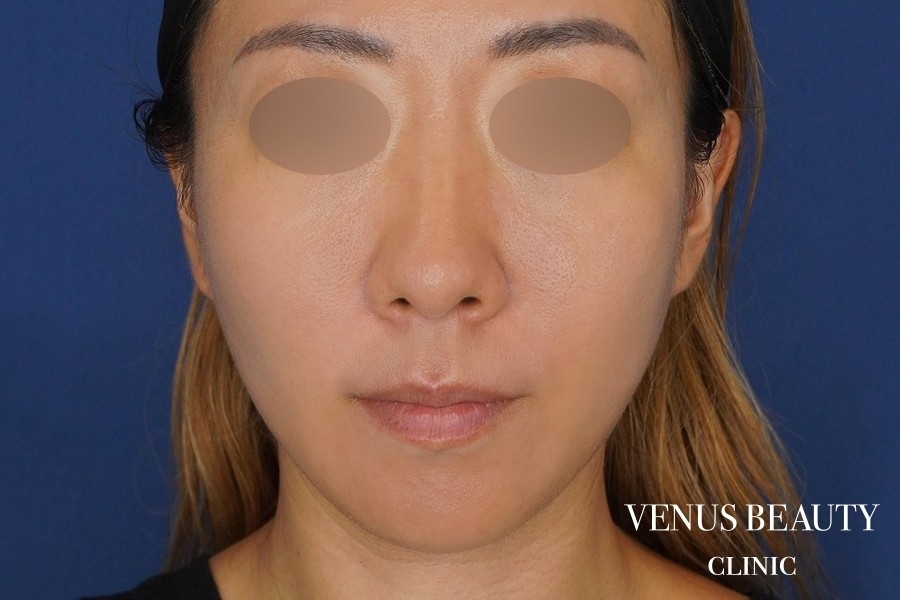 糸リフト＋脂肪吸引 施術後