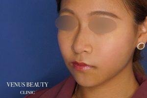 糸リフト＋脂肪吸引 施術後