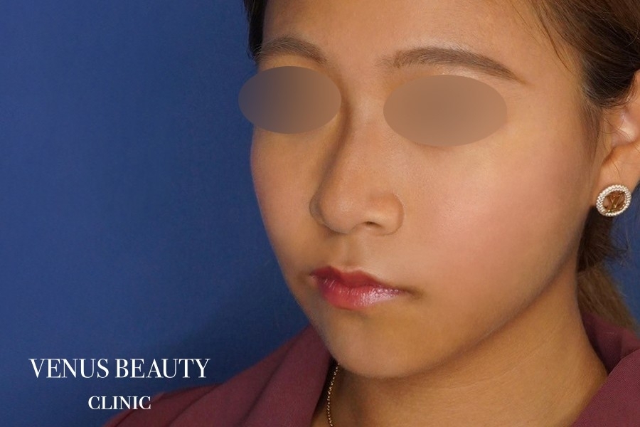 糸リフト＋脂肪吸引 施術後