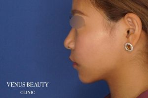 糸リフト＋脂肪吸引 施術後