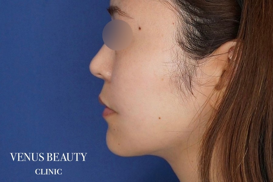 糸リフト＋脂肪吸引 施術後