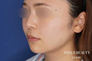 糸リフト＋脂肪吸引 施術後