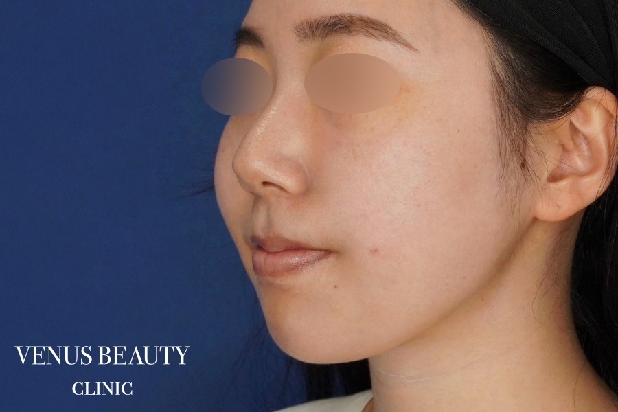 糸リフト＋脂肪吸引 施術後