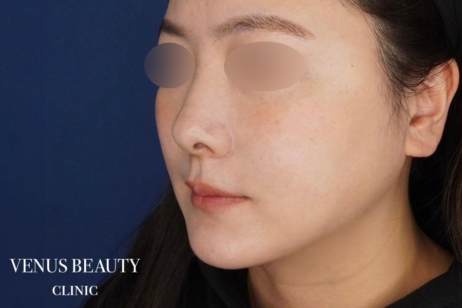 糸リフト＋脂肪吸引 施術後