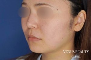 糸リフト＋脂肪吸引 施術前