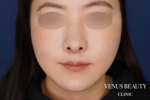 糸リフト＋脂肪吸引 施術後