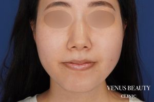 糸リフト＋脂肪吸引 施術後