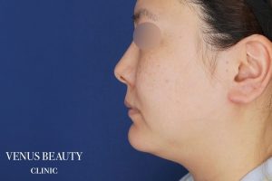 糸リフト＋脂肪吸引 施術前