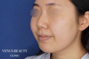 糸リフト＋脂肪吸引 施術前