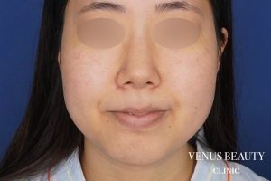 糸リフト＋脂肪吸引 施術前