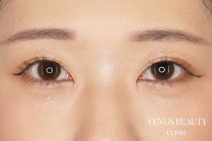 二重まぶた全切開法 施術後