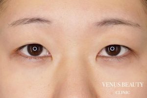 二重まぶた全切開法 施術前