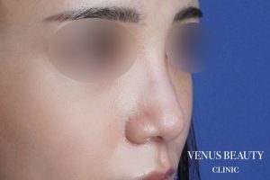 骨切幅寄せ 施術後