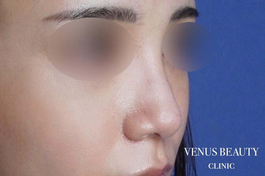 骨切幅寄せ 施術後