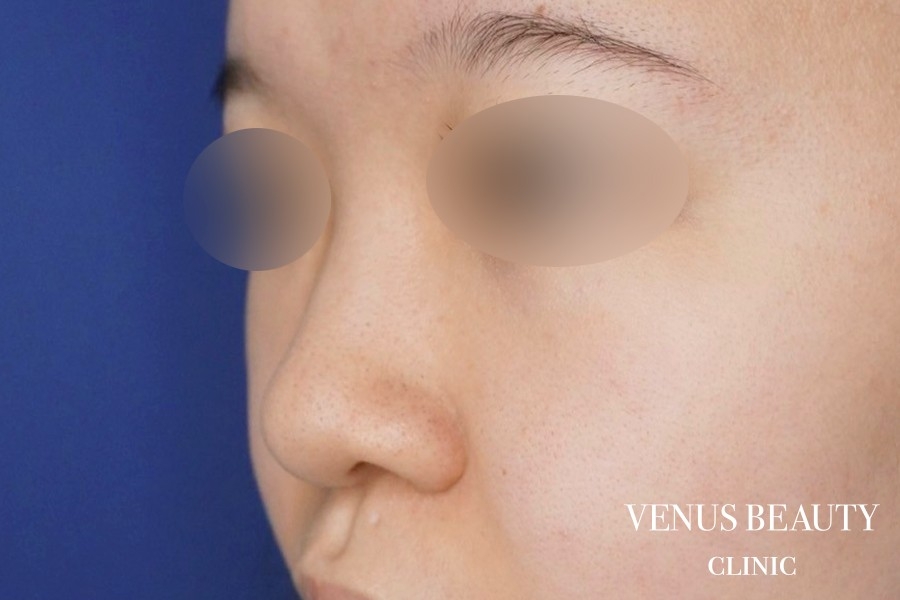 鼻中隔延長 施術前