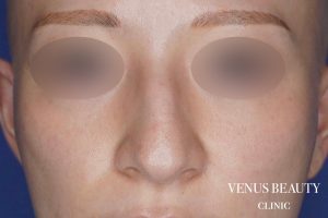 骨切幅寄せ 施術前