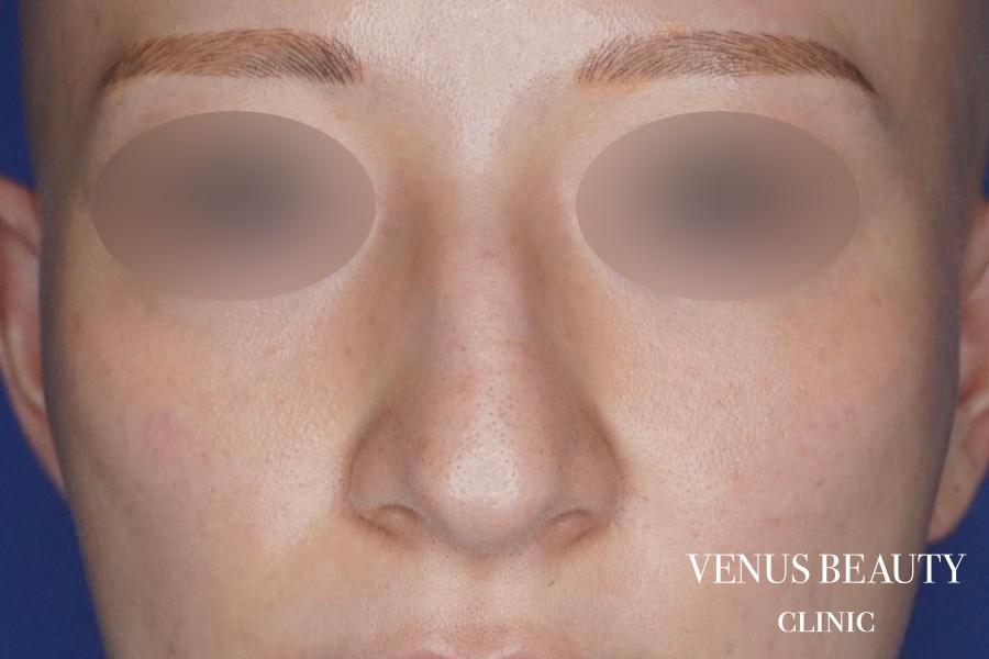 骨切幅寄せ 施術前