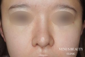 骨切幅寄せ 施術後