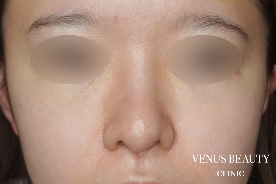 骨切幅寄せ 施術後