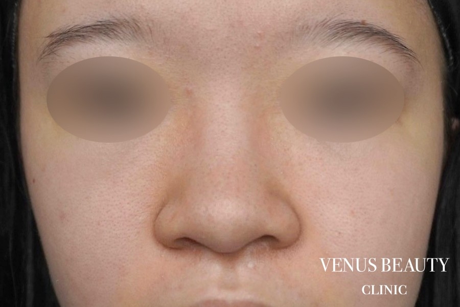 骨切幅寄せ 施術前