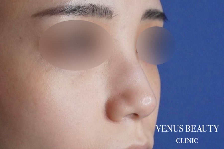 骨切幅寄せ 施術前