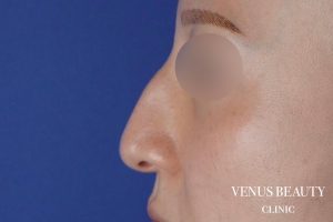 わし鼻・段鼻修正 ハンプ切除 施術前