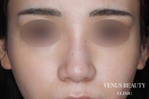 骨切幅寄せ 施術後