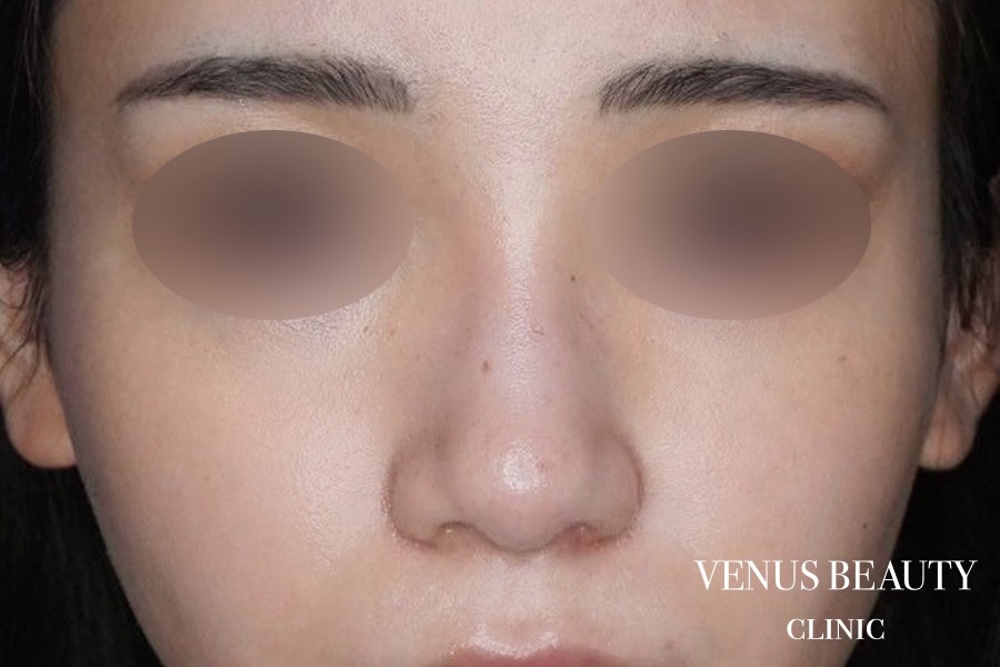 骨切幅寄せ 施術後