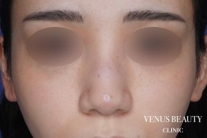 骨切幅寄せ 施術前